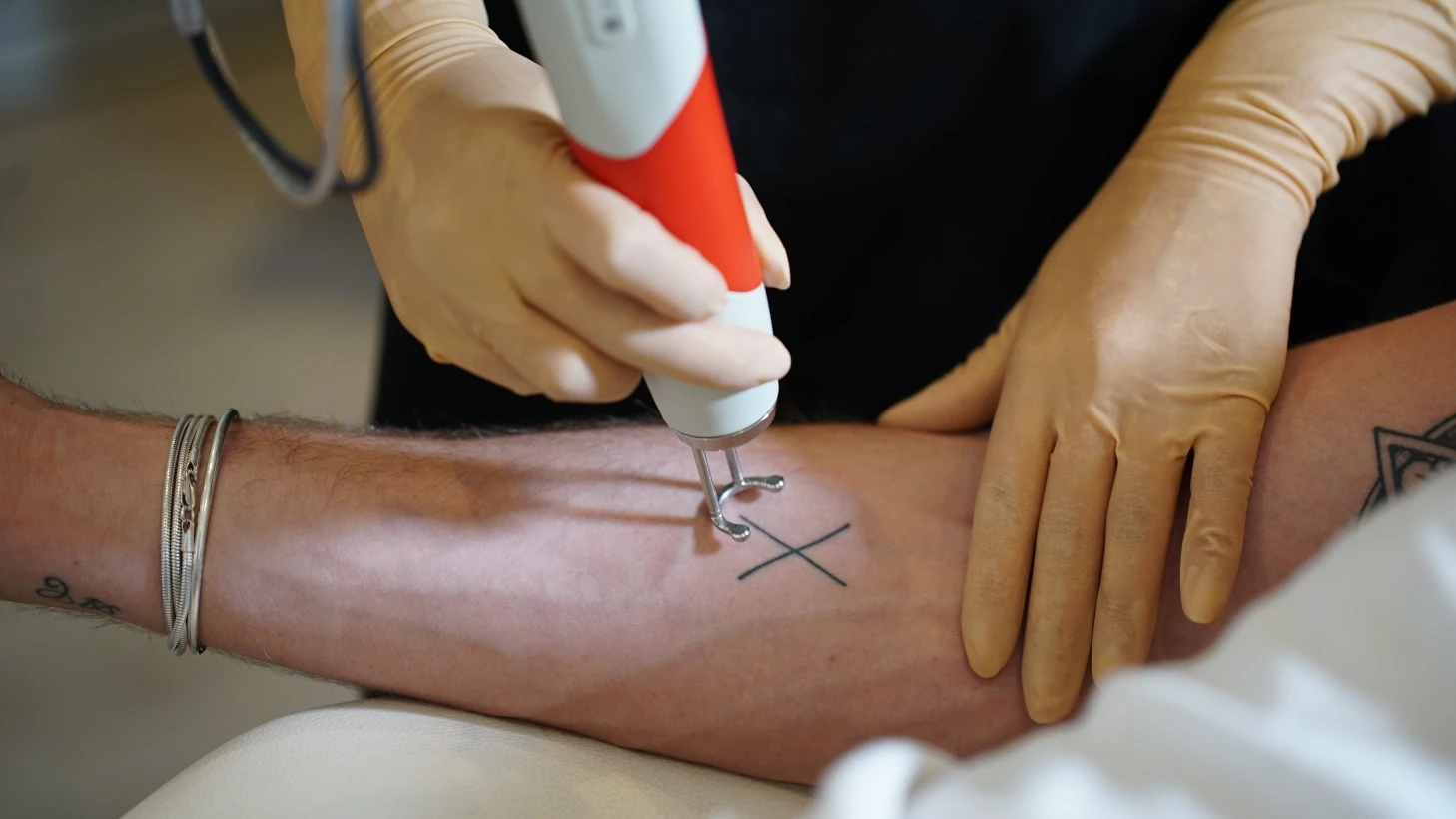 Séance de détatouage laser avant une nouvelle dermopigmentation
