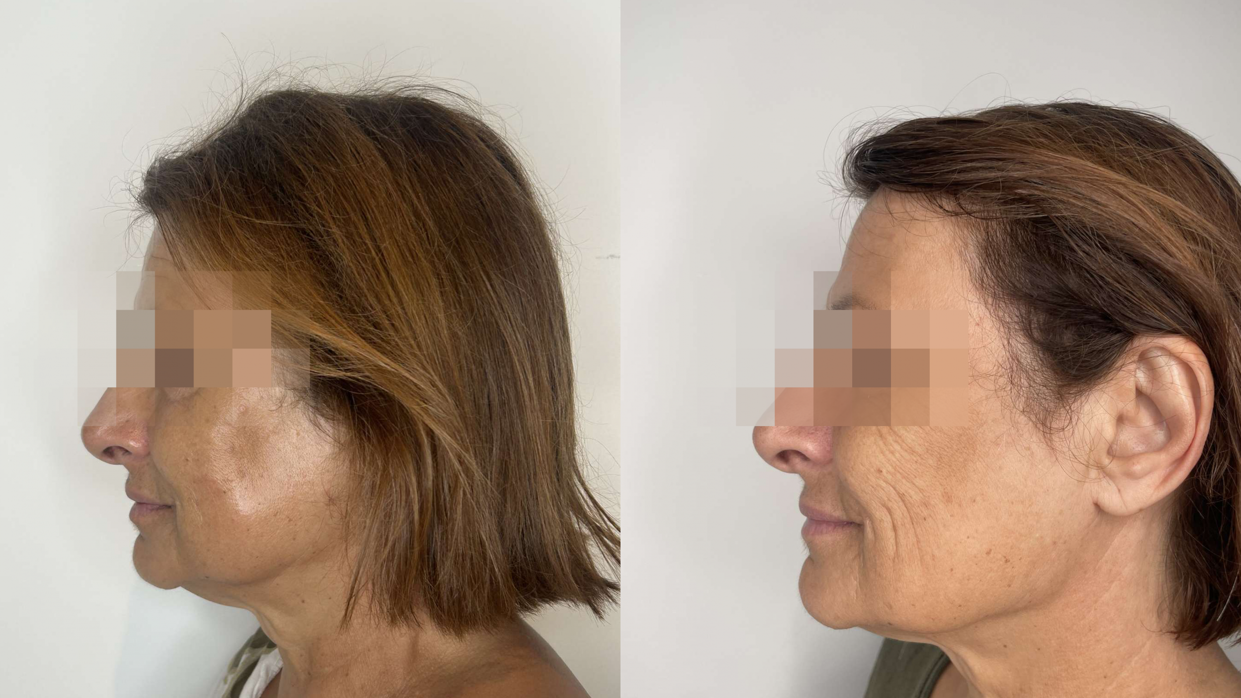 Avant après traitement du fripé des joues par inducteur de collagène, Phenicia Medical Spa Marseille