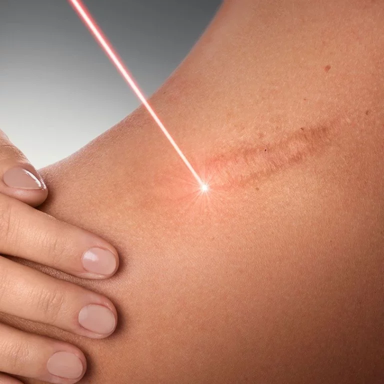 comment-medecine-esthetique-reduit-cicatrices-chirurgicales-marseille